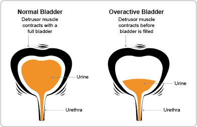 Overactive Bladder Symptoms Causes And Treatment