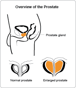 Panoramica della prostata